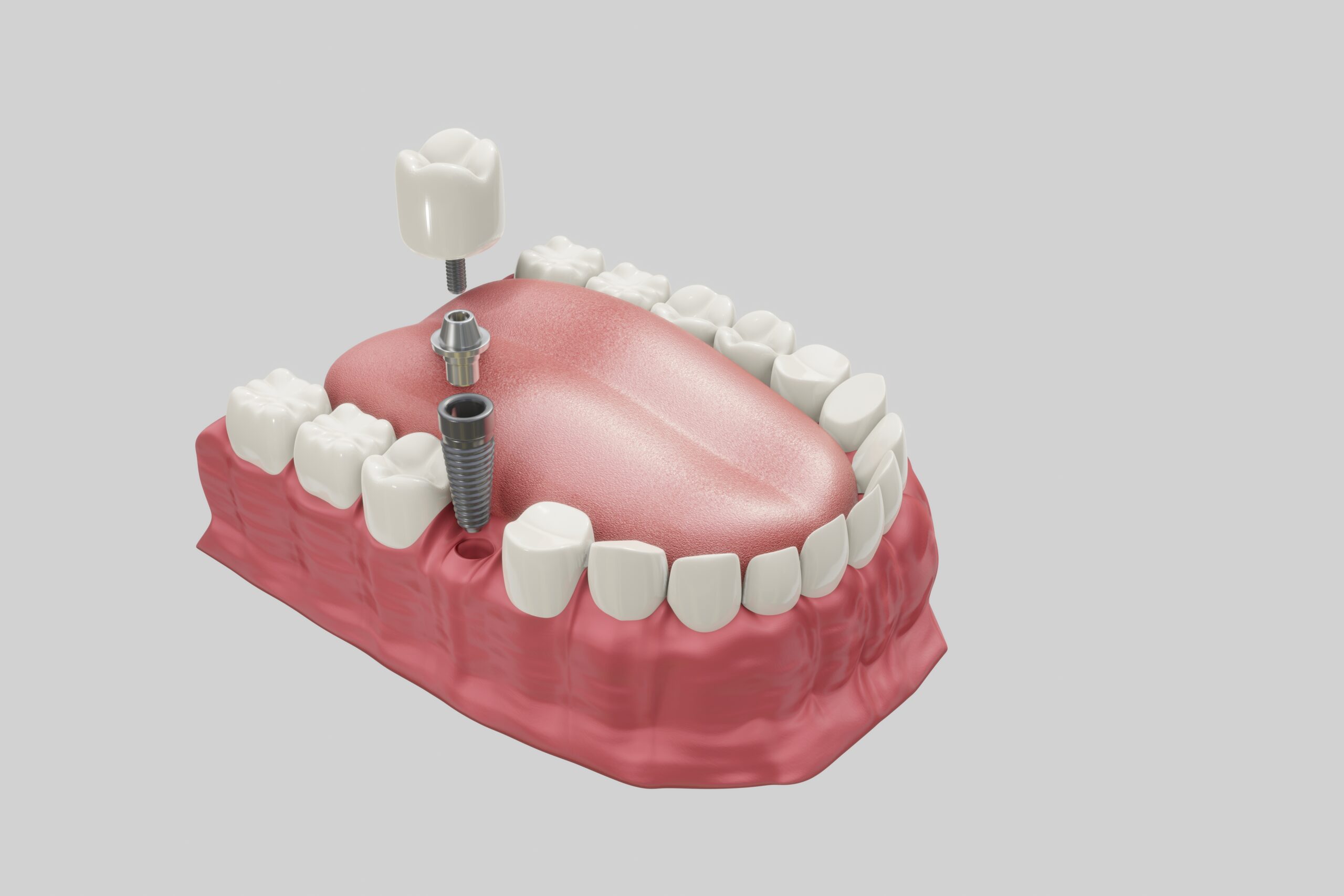 Dentures Versus Dental Implants